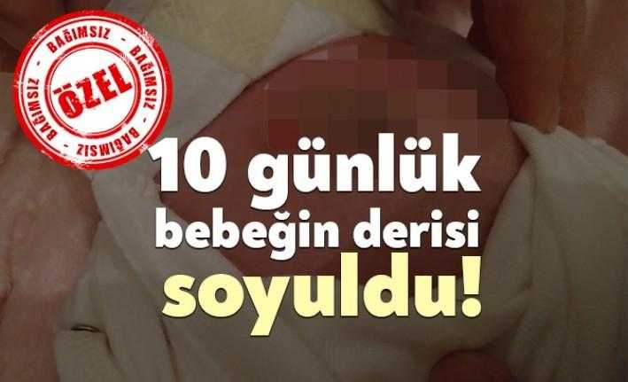 İlimizdeki özel bir hastanede doğan bebek, göbek deliğinde oluşan iltihap