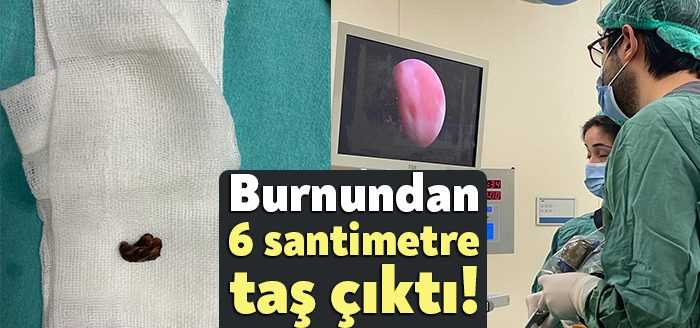 8 yıldır yaşadığı burun tıkanıklığı ve nefes alamama sorunu nedeniyle
