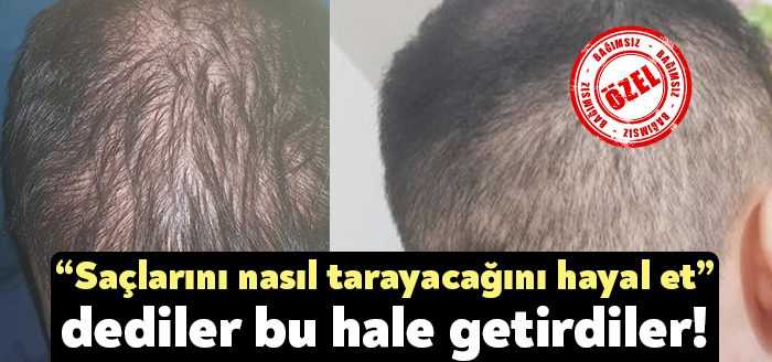 Kocaeli’de özel bir hastanede saç ekimi yaptıran vatandaşın ektirdiği yerler